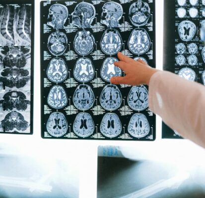 How does ketamine work in the brain? What to know.